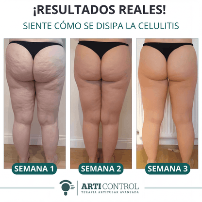 Celu Lift | Arti Control | Disuelve tu Celulitis Antes de Verano